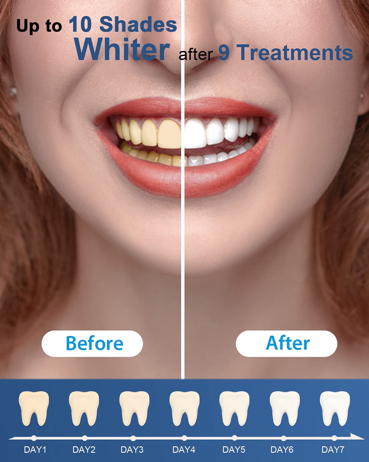 MySmile Teeth Whitening Kit with Whitening Light - 4Pcs Non-Sensitive Enamel Safe Teeth Whitening Gel,10 Min Fast-Result Home Tooth Whitening Dental Care Help Remove Teeth Stain 🍁 All In One Marketplace Canada